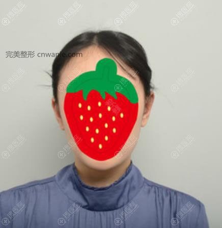 韓國普羅菲耳招風耳整形術后2周恢復效果