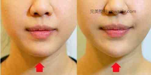 玻尿酸<a href='/tag_dianxiabaduoshao.html'>墊下巴多少錢</a>一針要幾支才定型？玻尿酸墊下巴多久恢復(fù)自然