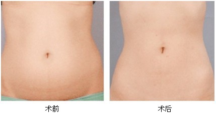 <a href='/tag_xizhishu3.html'>吸脂術(shù)</a>