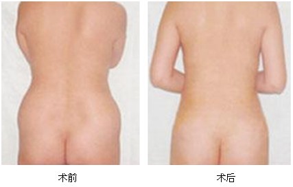 吸脂術(shù)